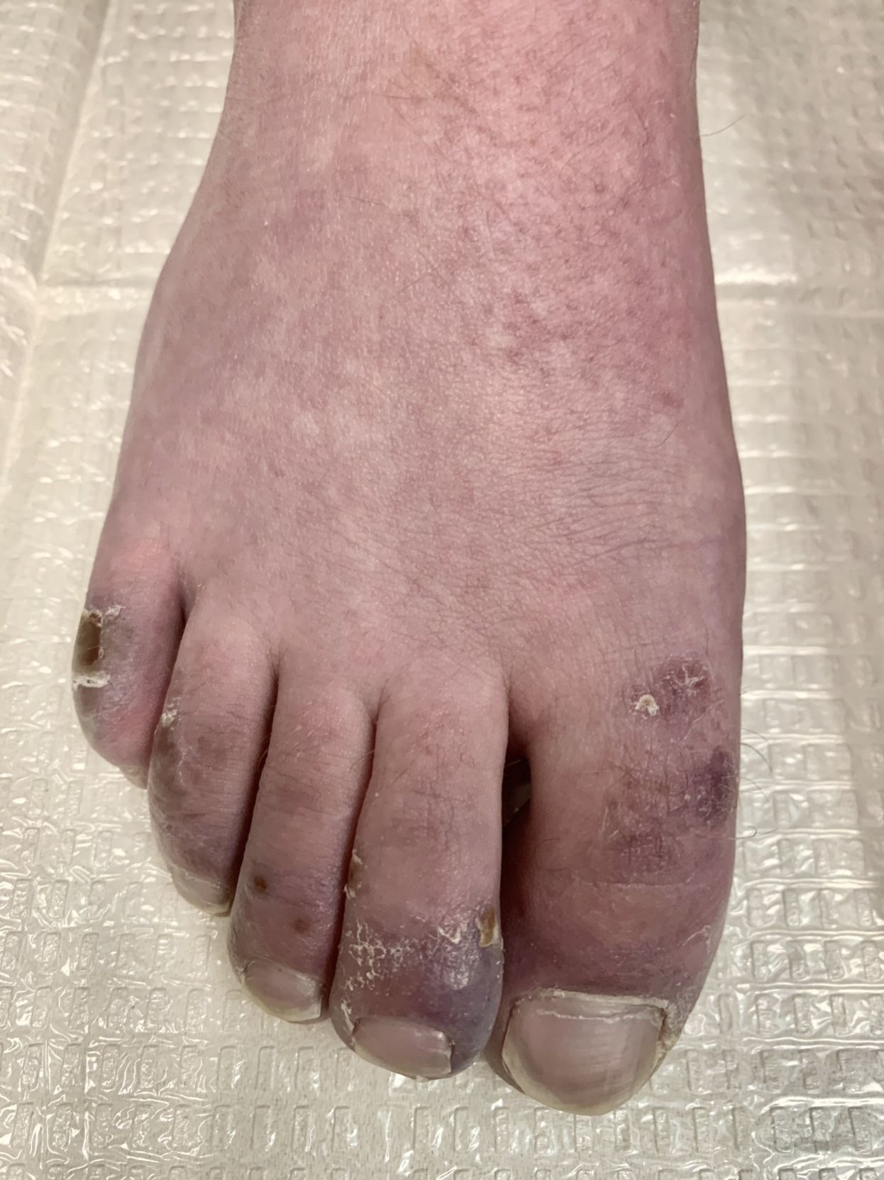 COVID toes